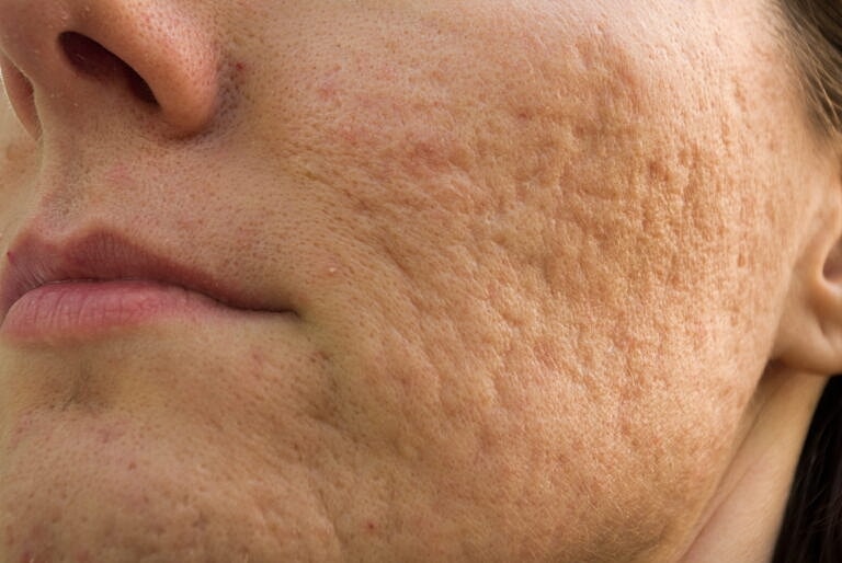 Close-up of textured skin on a face.