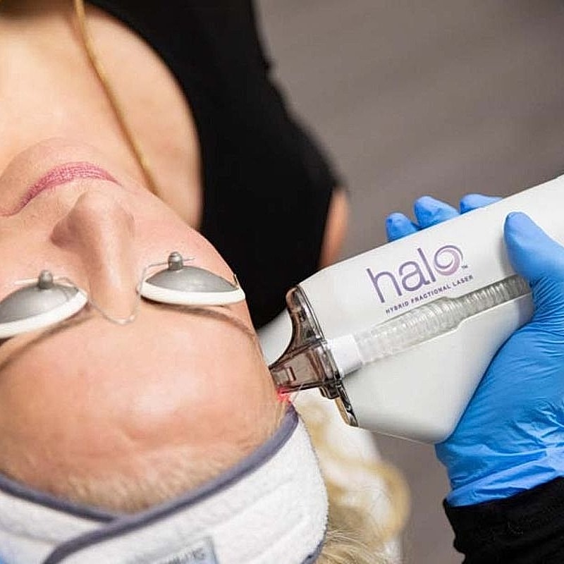 Halo laser treatment on a client’s face.