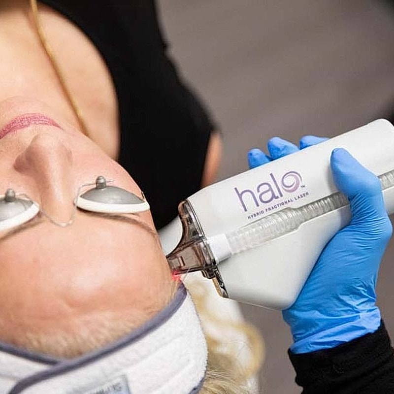 Woman receiving Halo laser treatment for skin.