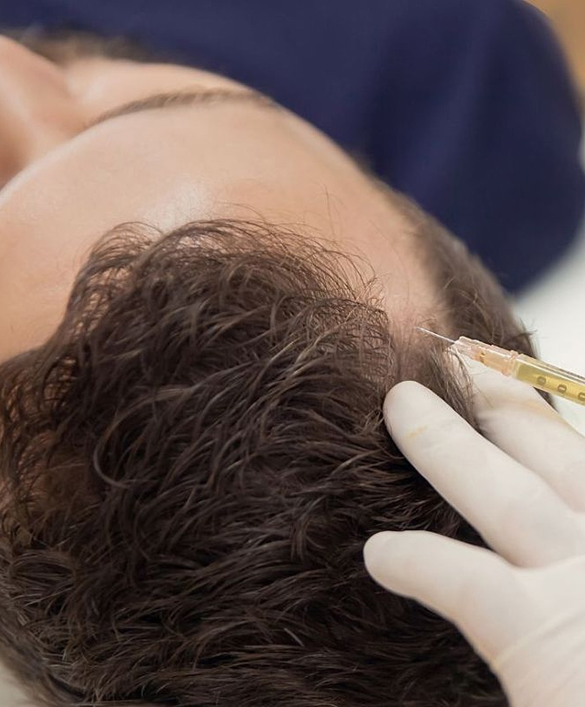 Hair treatment injection procedure on scalp.