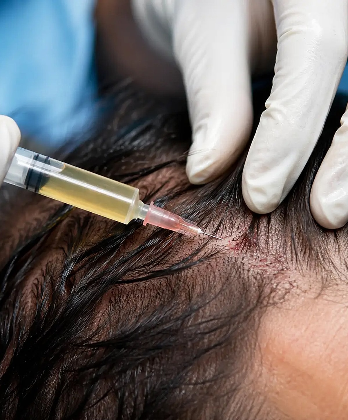 Hair restoration procedure with injection on scalp.