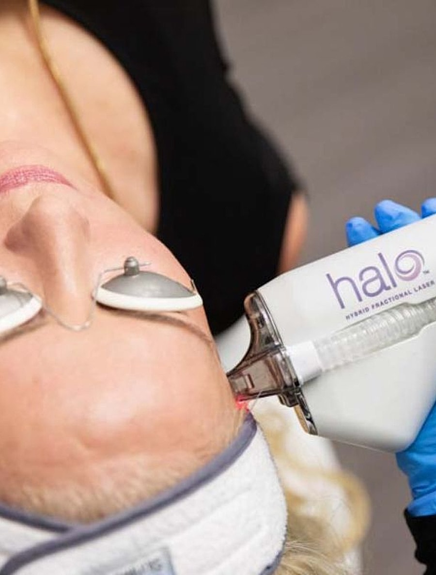 Woman receiving halo laser treatment on forehead.