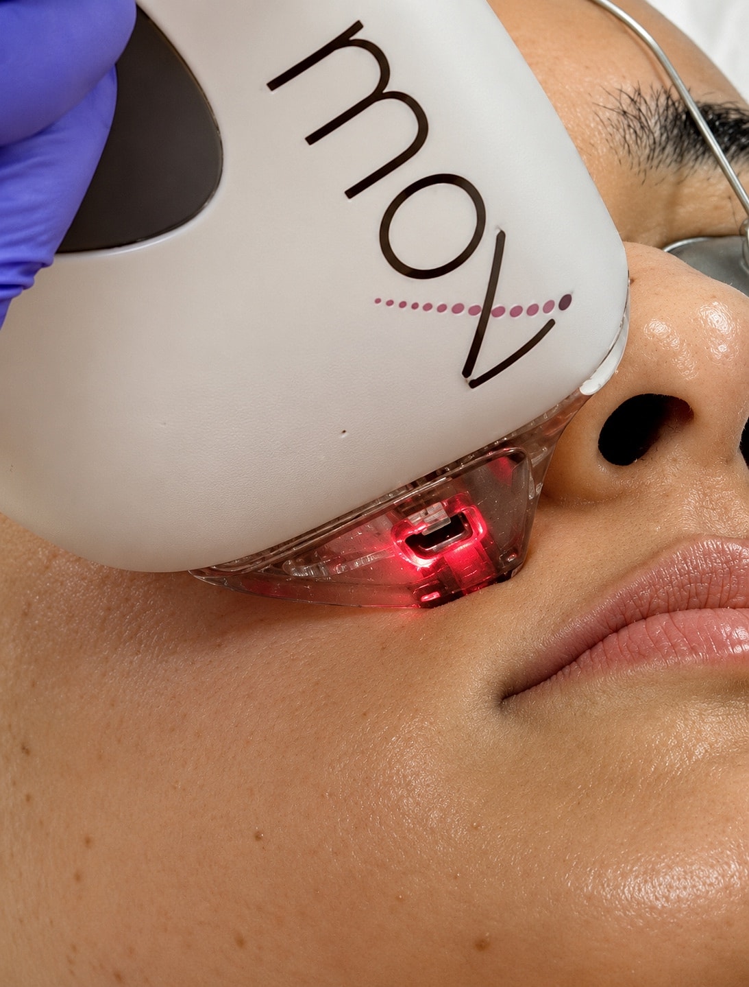 Laser treatment for skin rejuvenation.