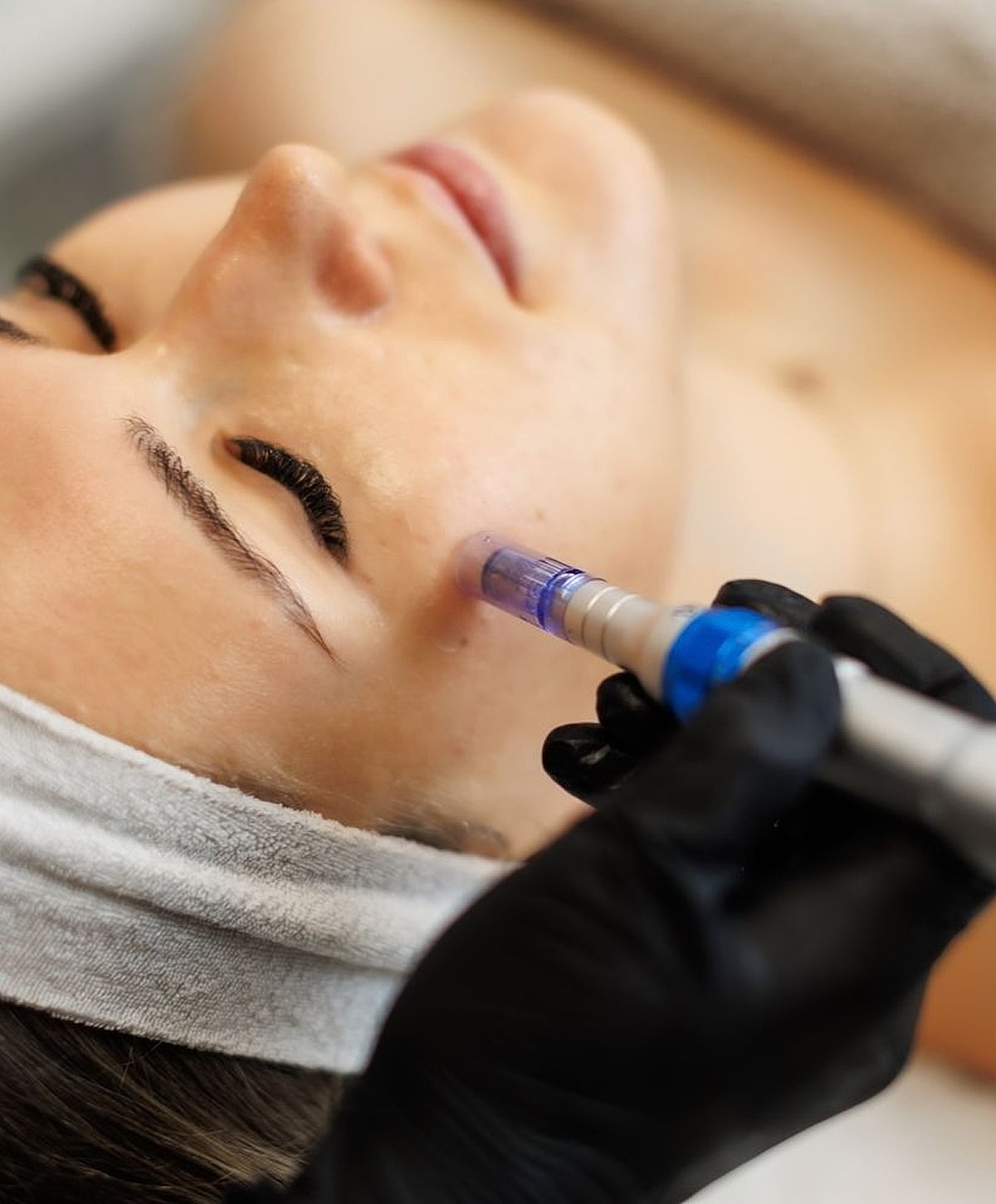 Facial treatment with a microneedling device.