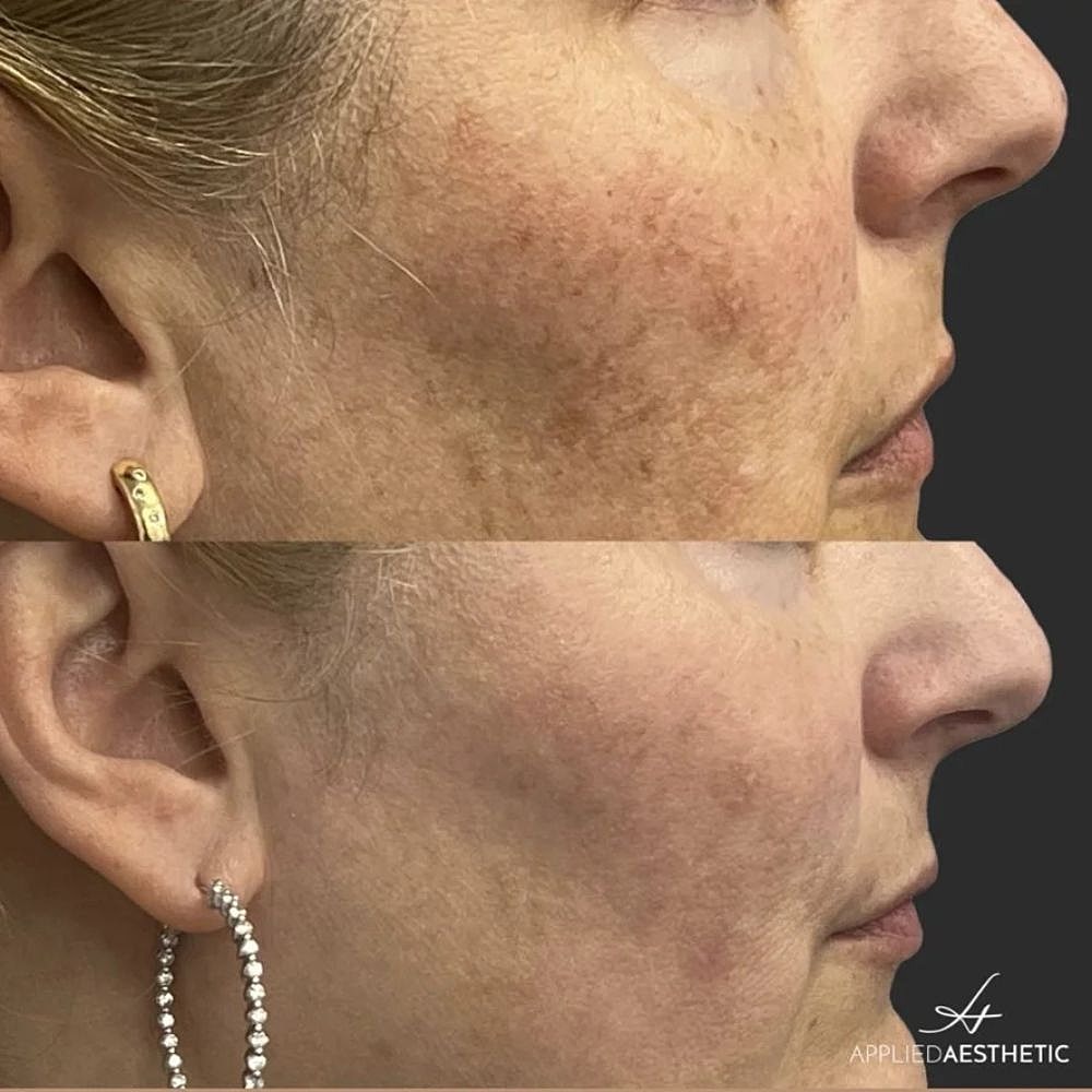 Before and after facial skin rejuvenation treatment.