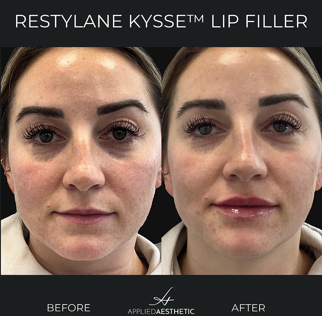 Dermal Fillers Before & After