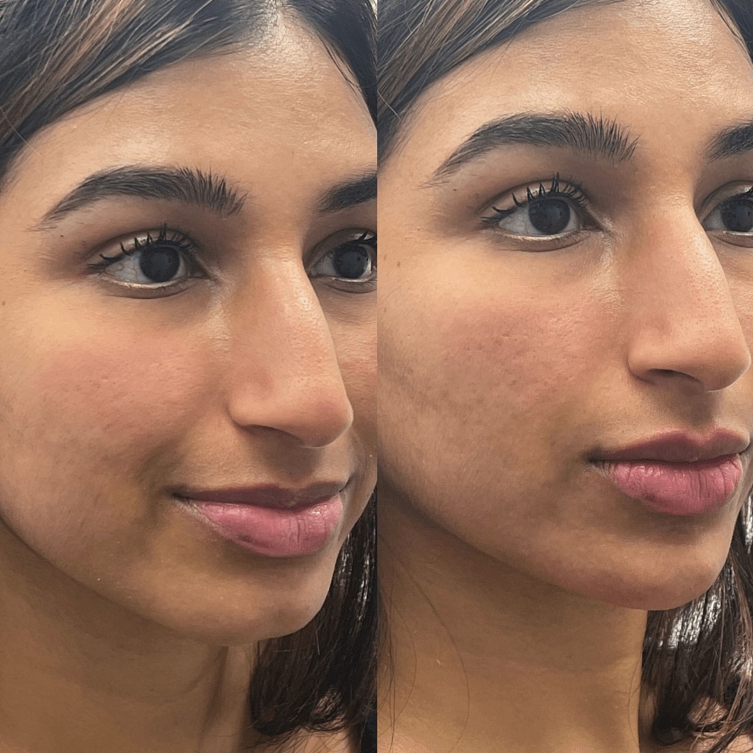 Dermal Fillers Before & After