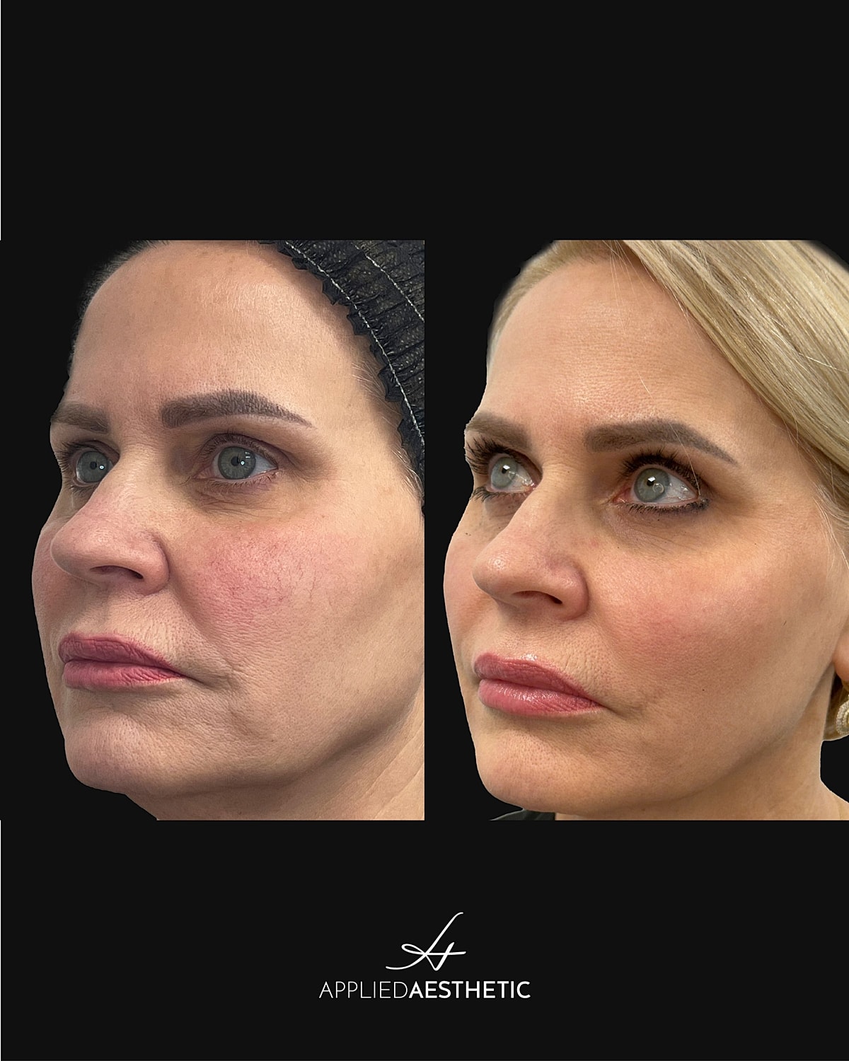 Halo Before & After