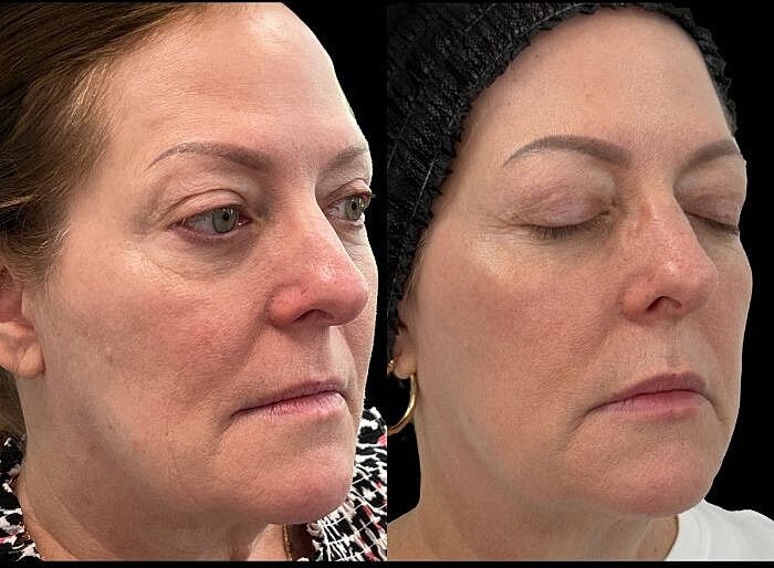Halo Before & After