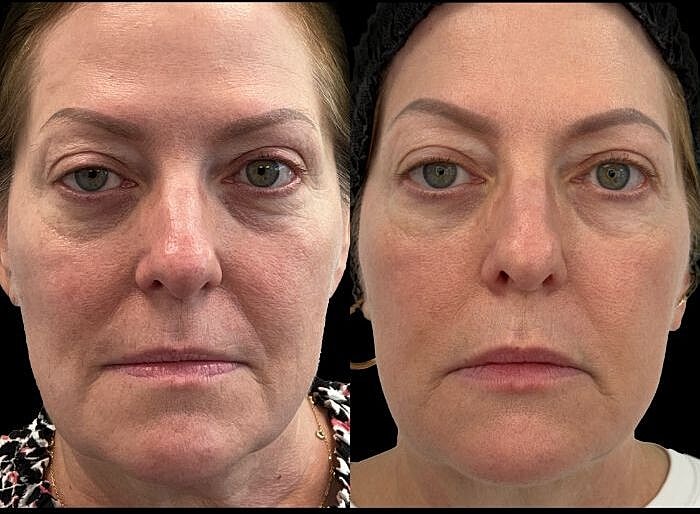 Halo Before & After