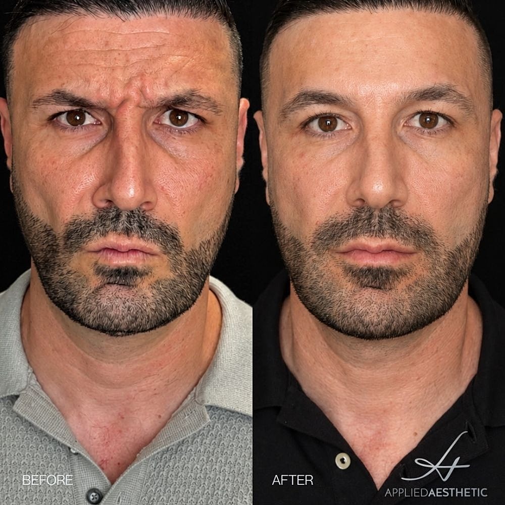 Botox Before & After