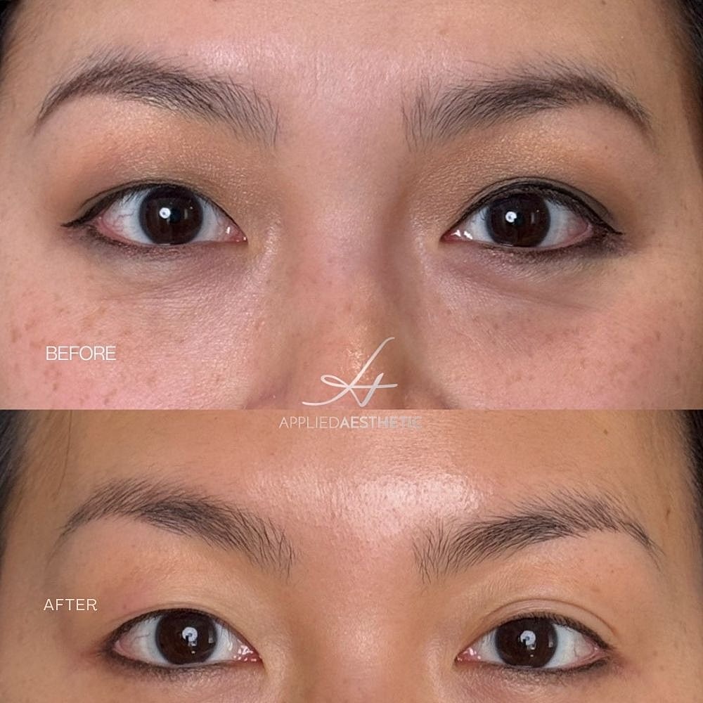 Botox Before & After