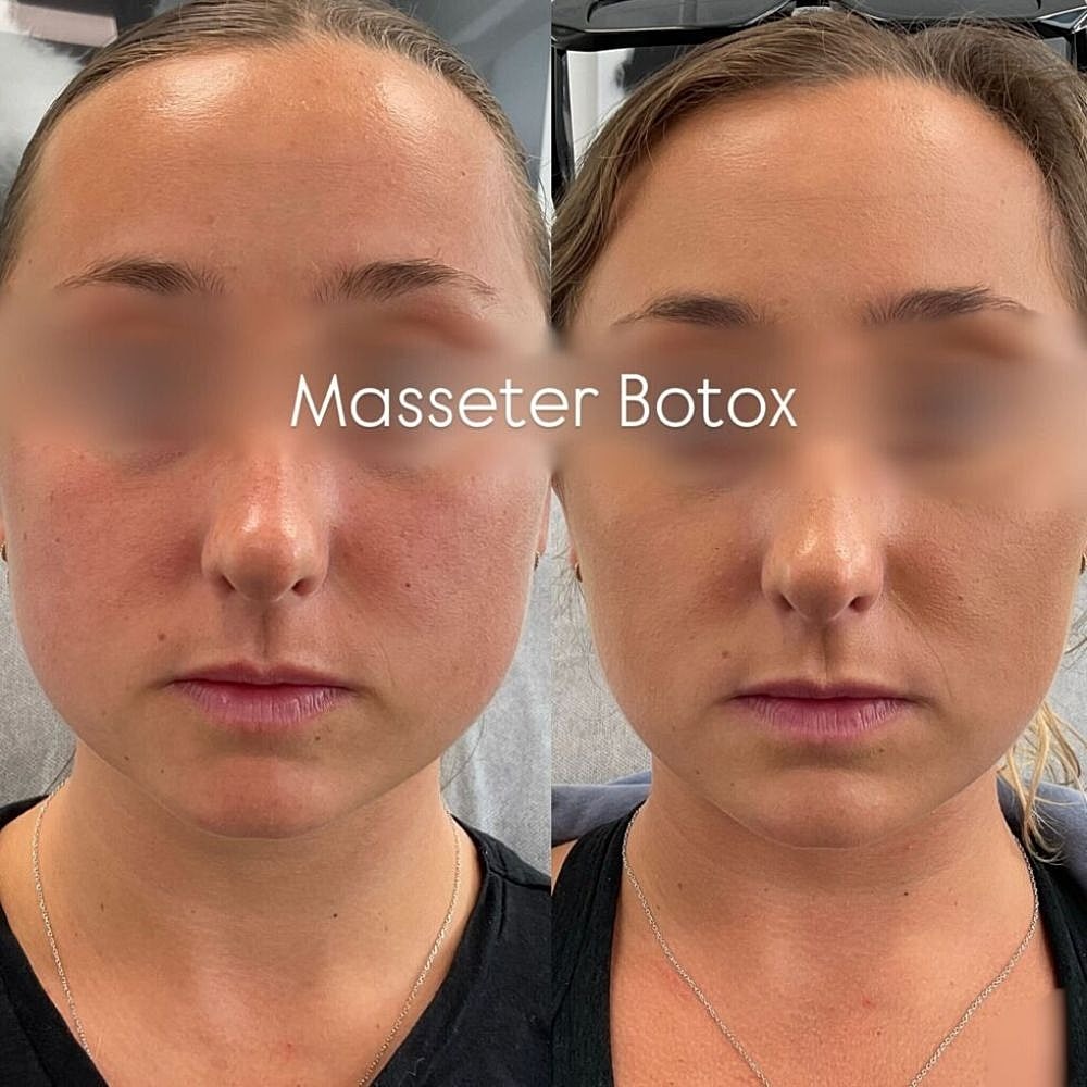 Botox Before & After
