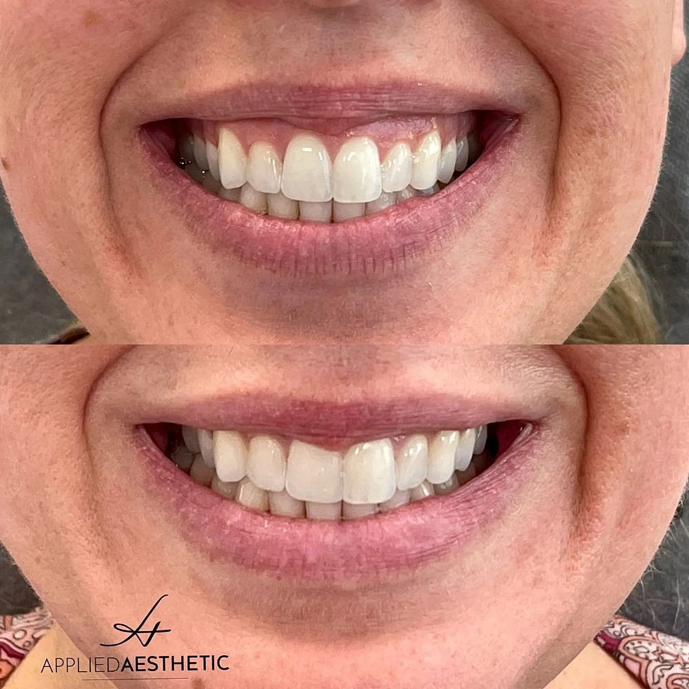 Botox Before & After