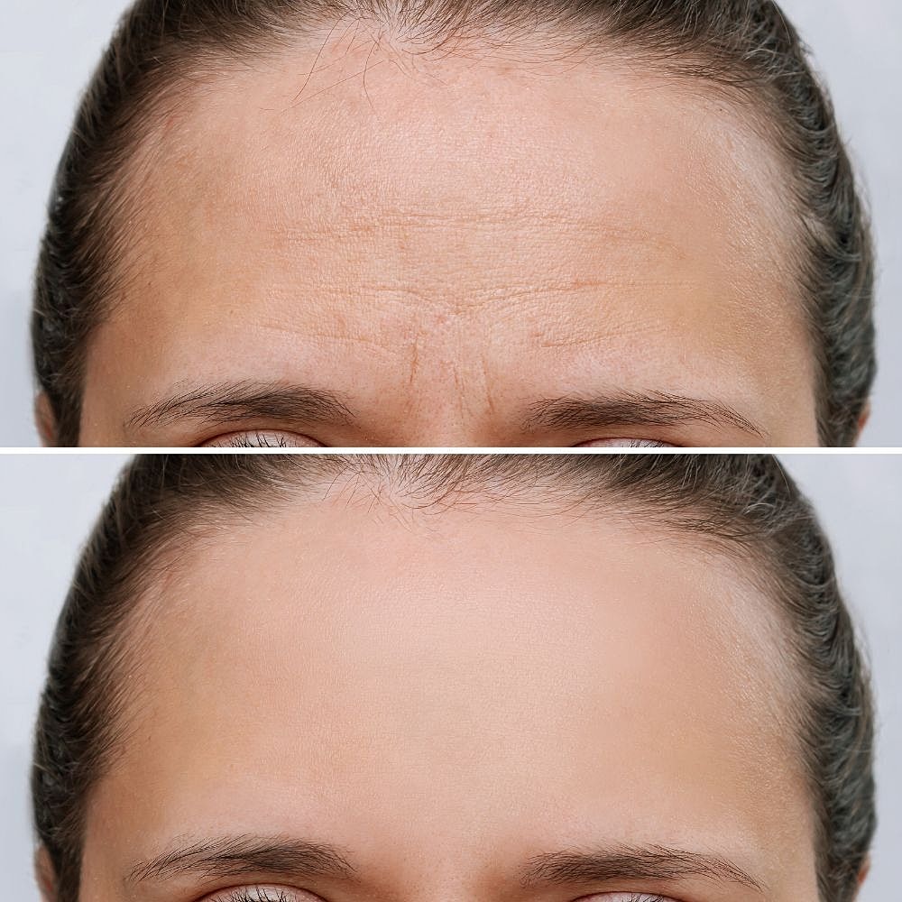 Botox Before & After