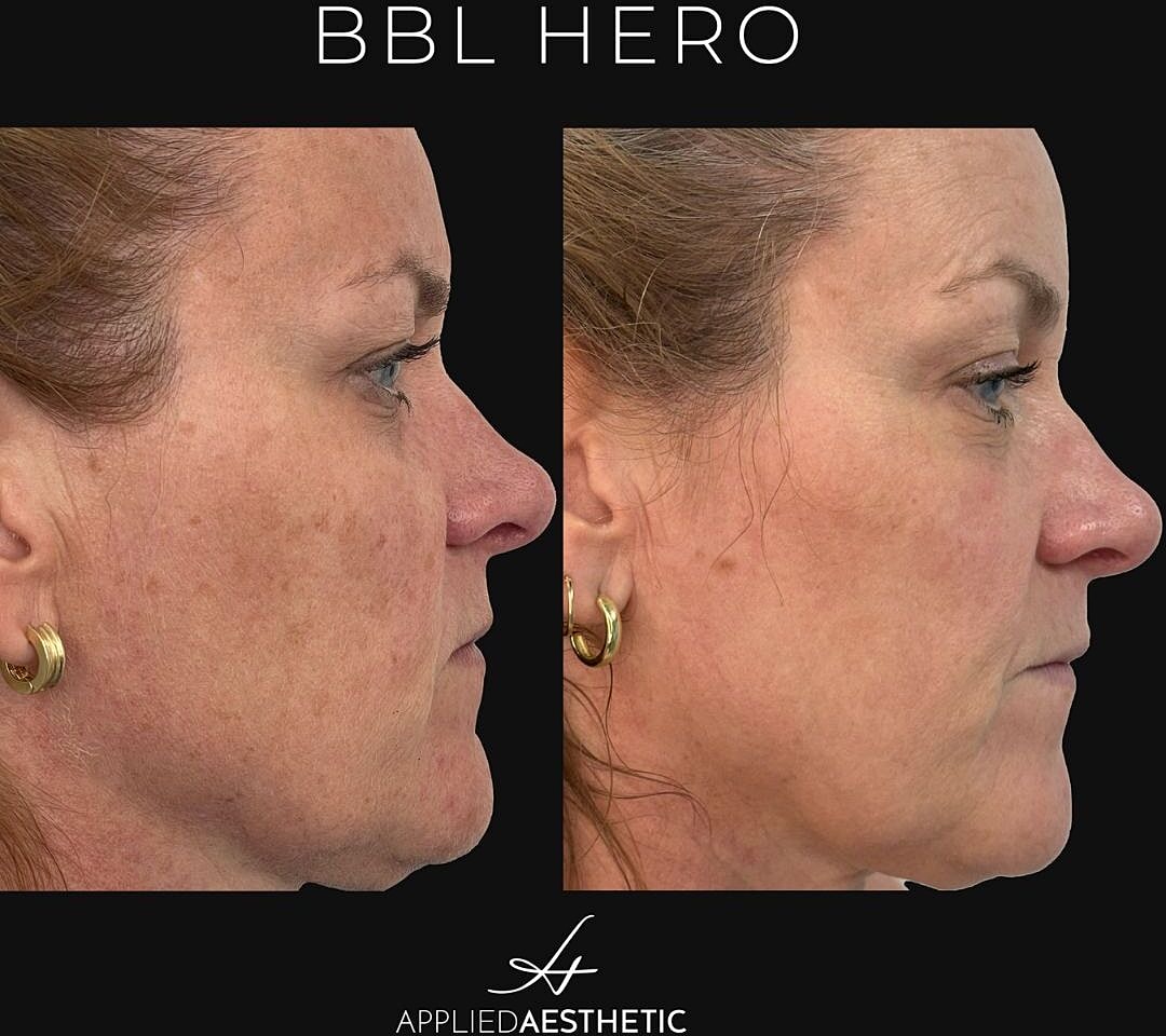 Bbl Moxi Before & After