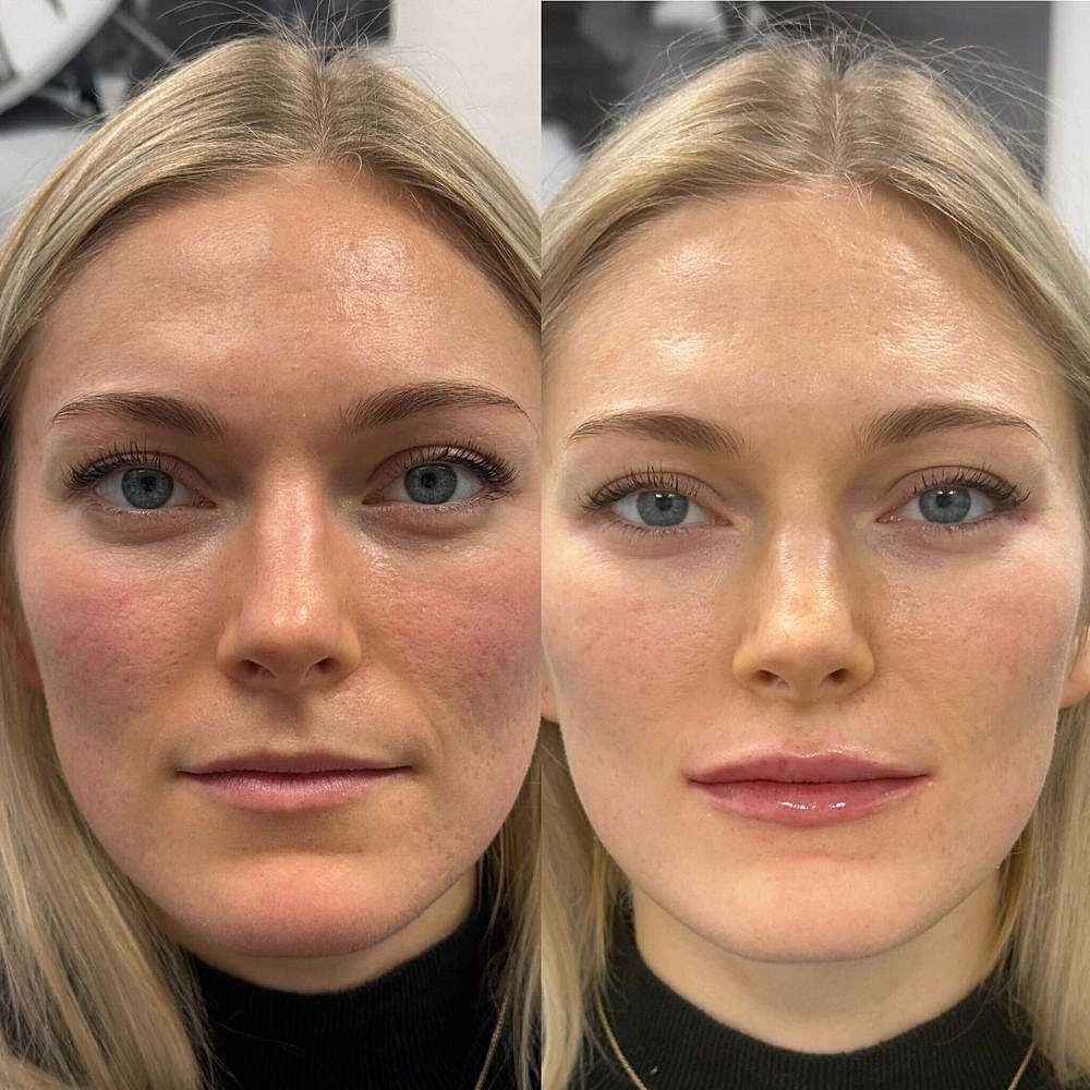 Lip Filler Before & After