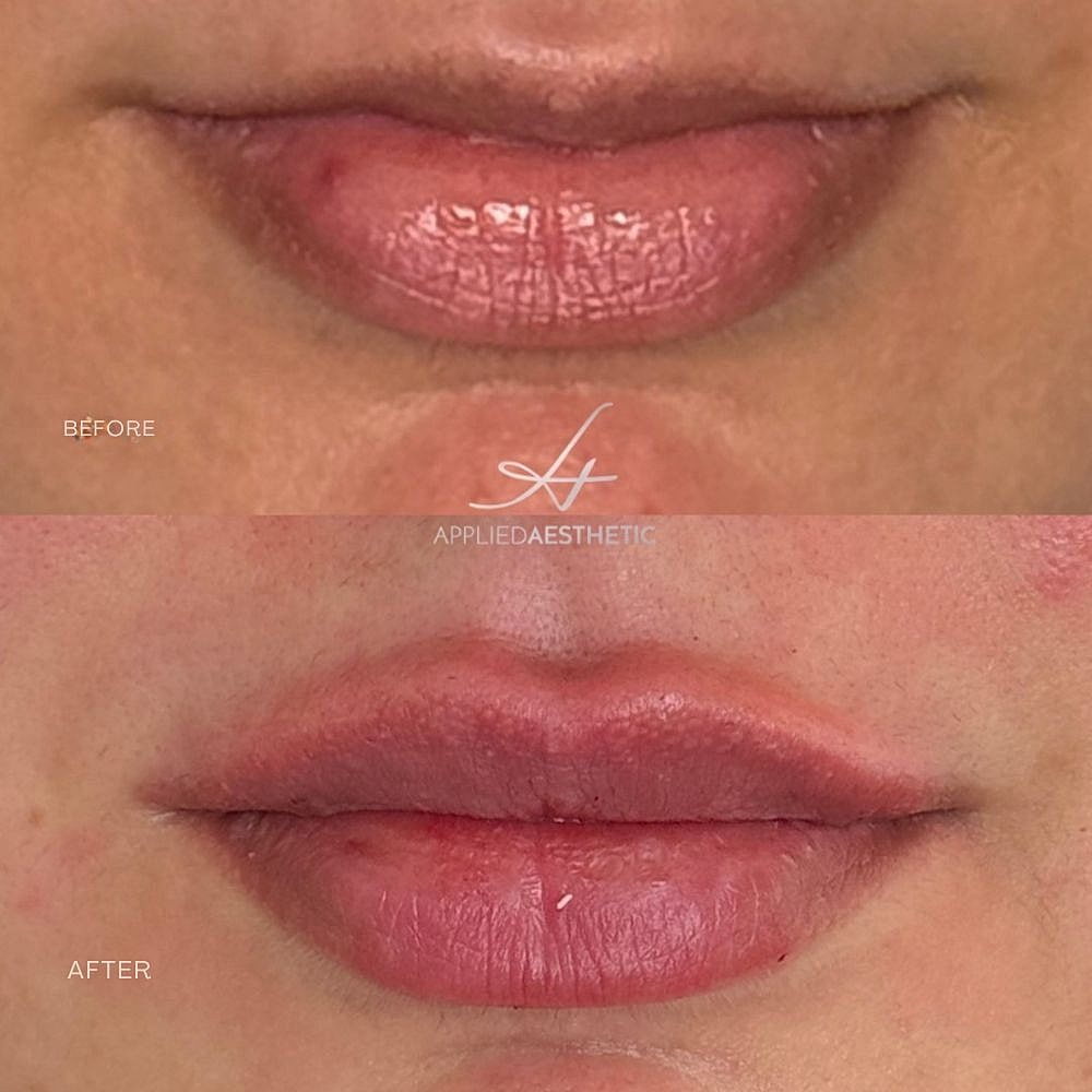 Lip Filler Before & After