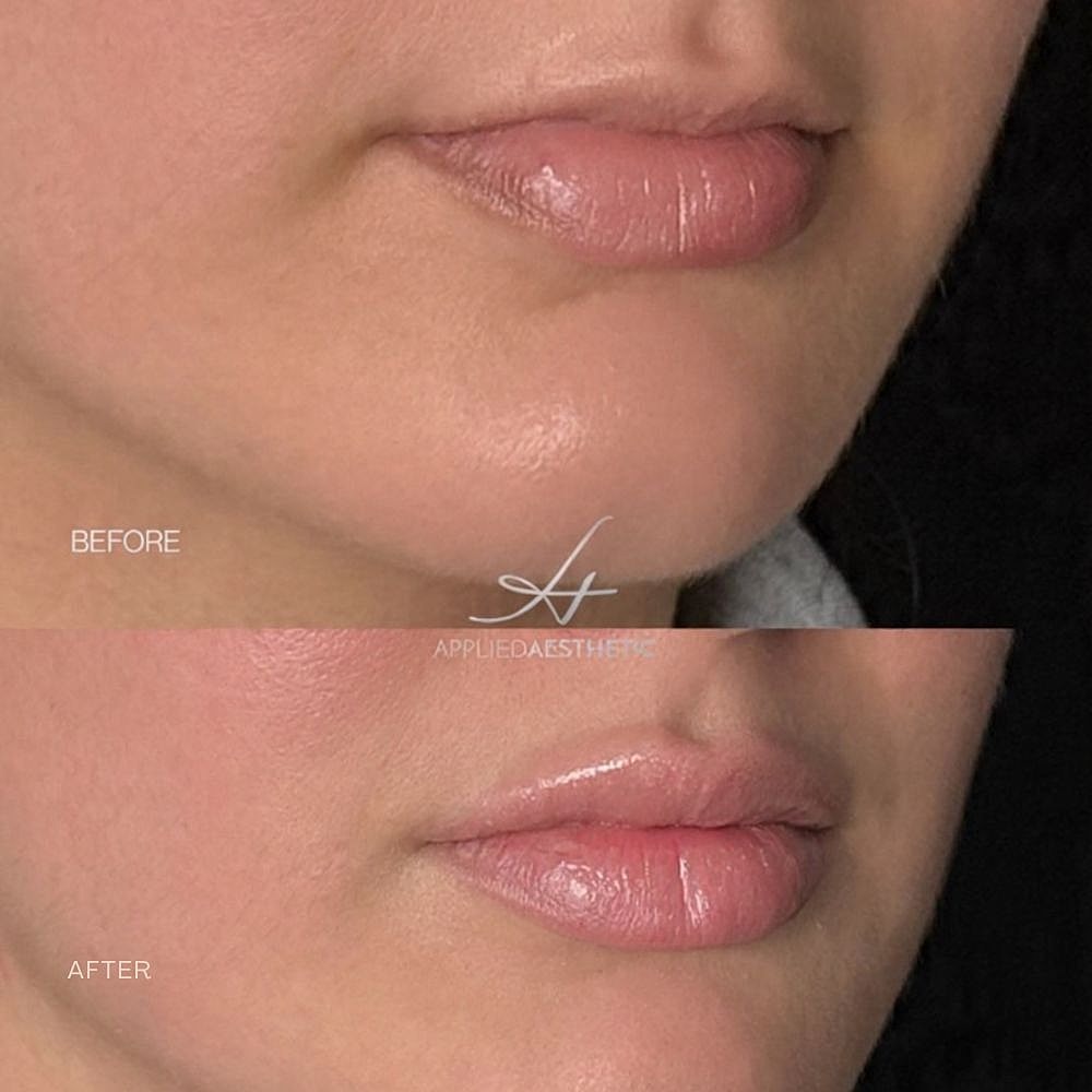 Lip Filler Before & After