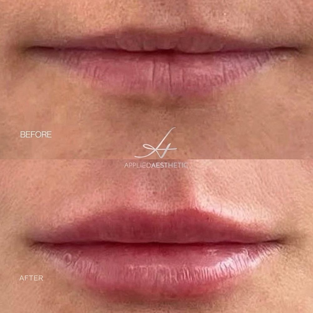 Lip Filler Before & After