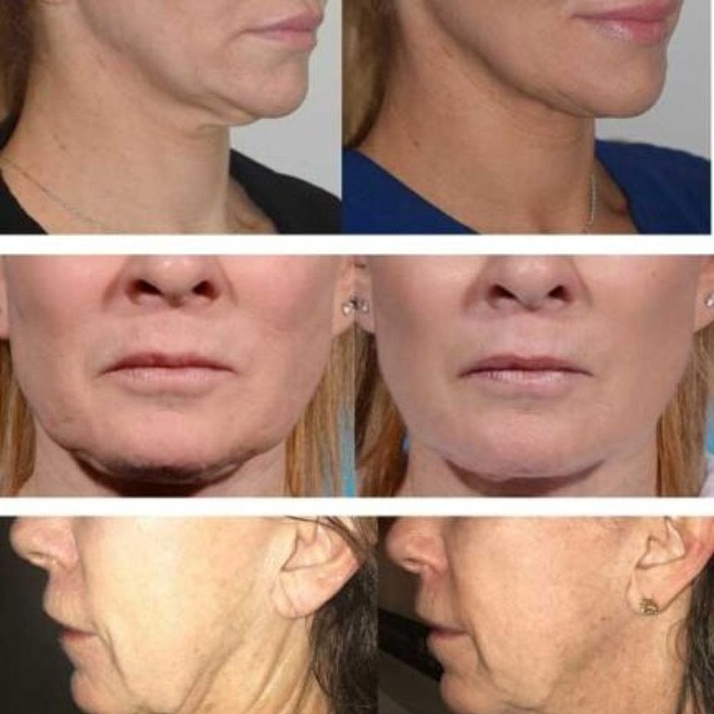 Morpheus 8 Before & After