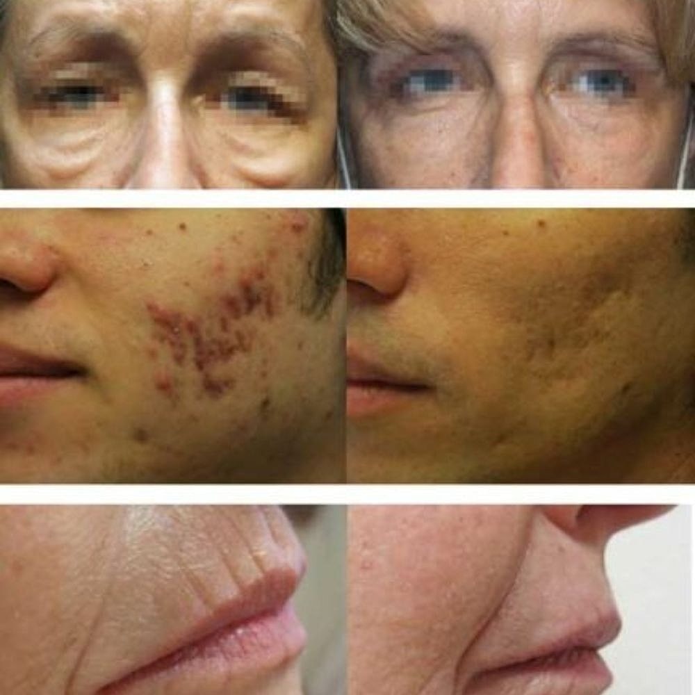 Morpheus 8 Before & After