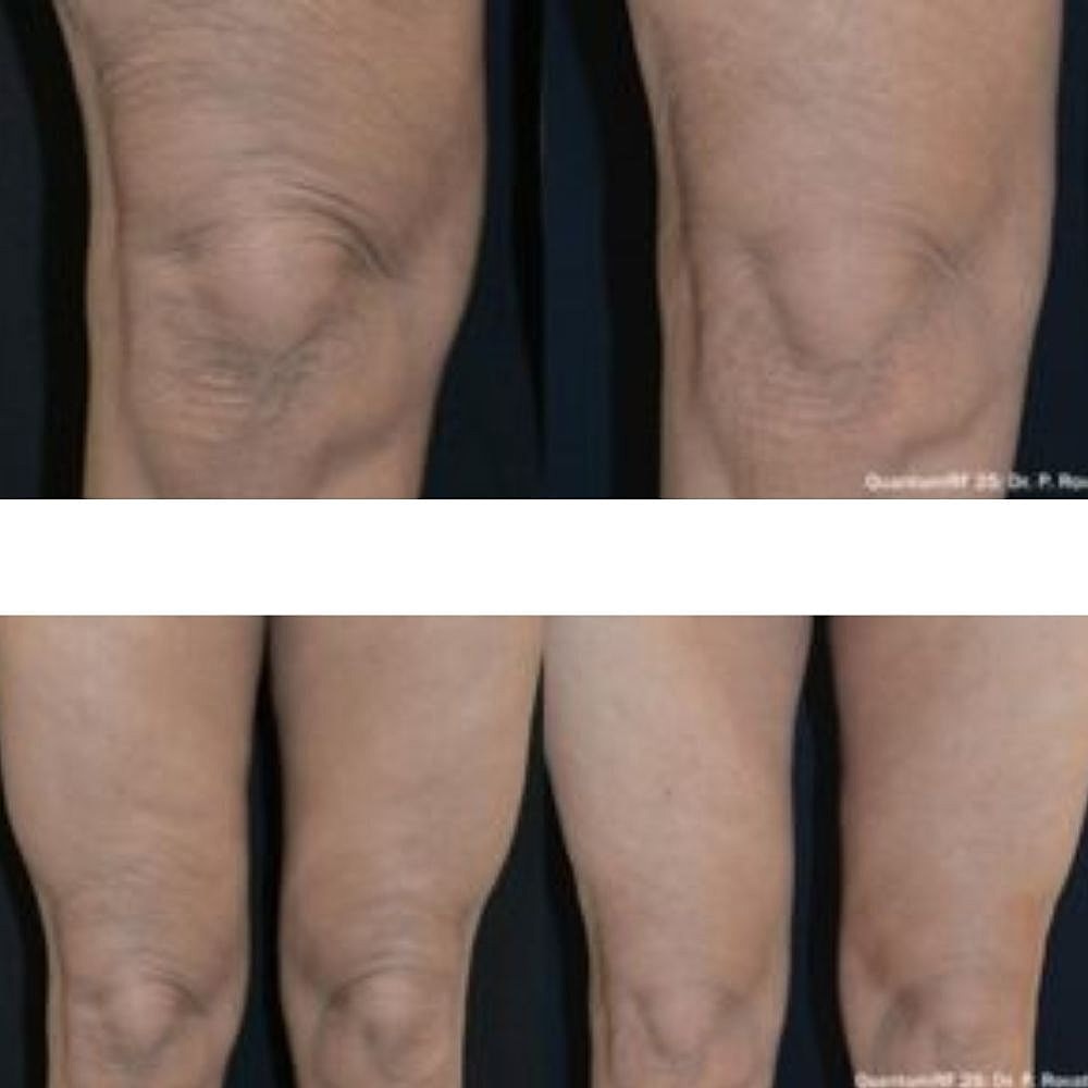 Morpheus 8 Before & After