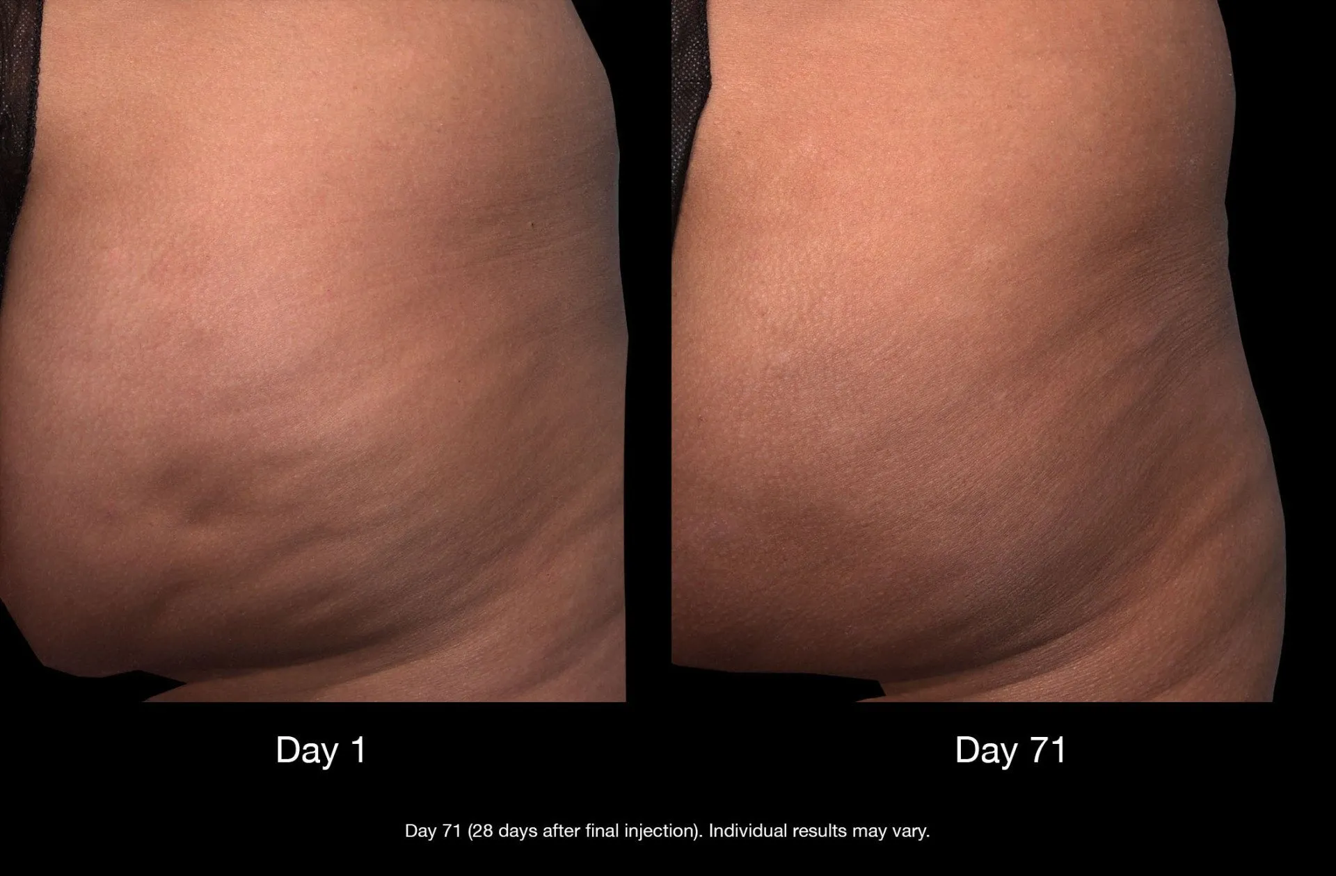 Cellulite QWO in Garden City, NY