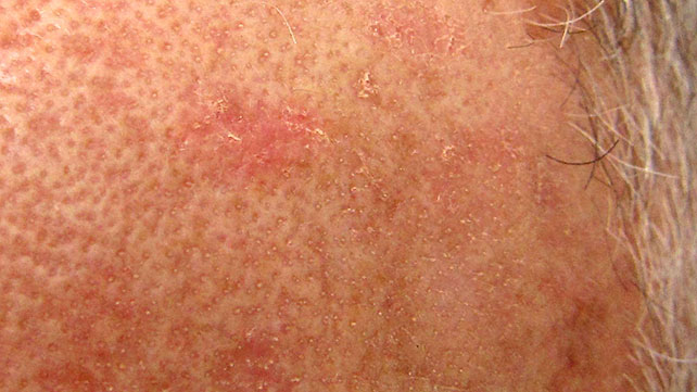 Actinic Keratosis  in Garden City, NY