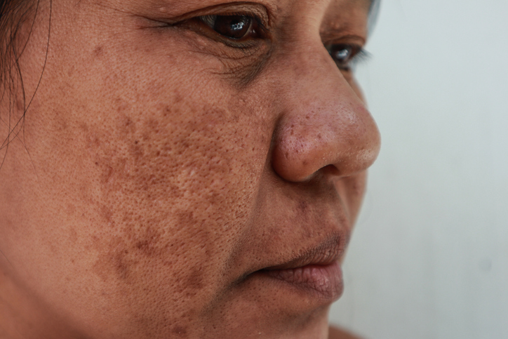 Melasma Treatment in Garden City, NY