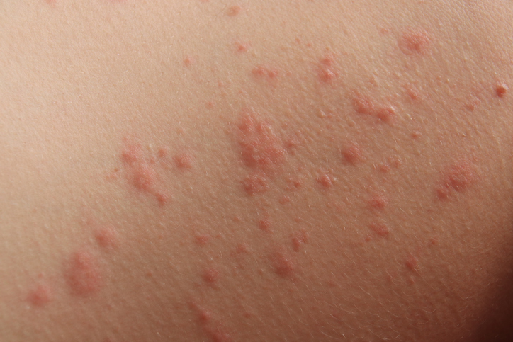 Contact Dermatitis in Garden City, NY