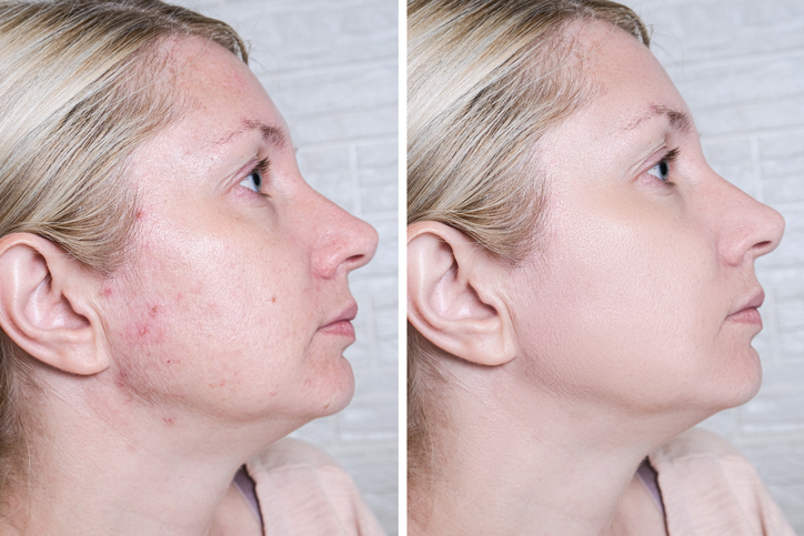 Acne Treatment in Garden City, NY