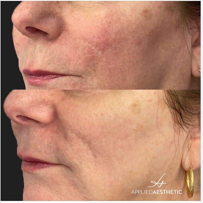 Rosacea Treatment in Garden City, NY