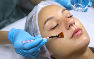 6 Reasons Why Chemical Peels Can Transform Your Skin