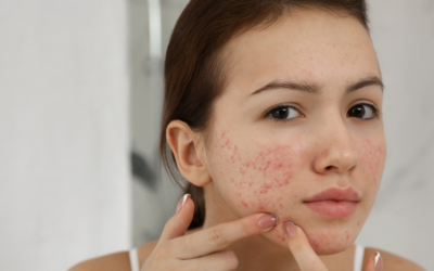 Understanding the Relationship Between Acne and Dry Skin