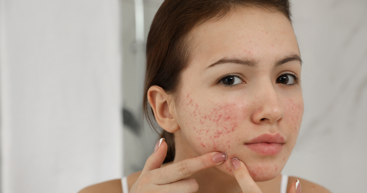 Understanding the Relationship Between Acne and Dry Skin - Applied Aesthetic