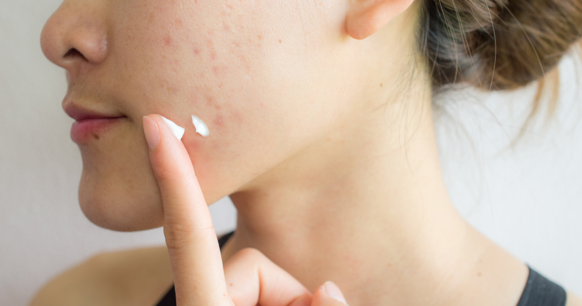 Understanding the Relationship Between Acne and Dry Skin - Applied Aesthetic