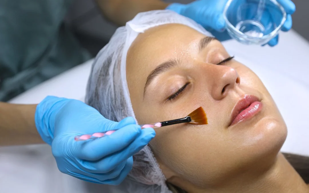 Chemical Peels Can They Effectively Treat Melasma?