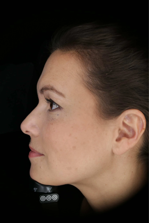 Acne Treatment in Garden City, NY