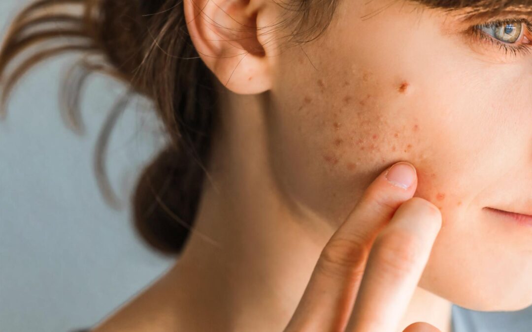 Personalized Acne Treatment Plans: Customizing Solutions for Different Skin Types