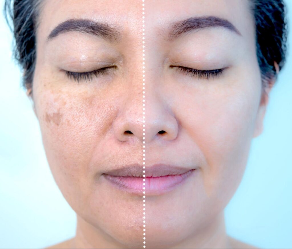 Reversing Sun Damage: Effective Treatments for Post-Summer Skin ...