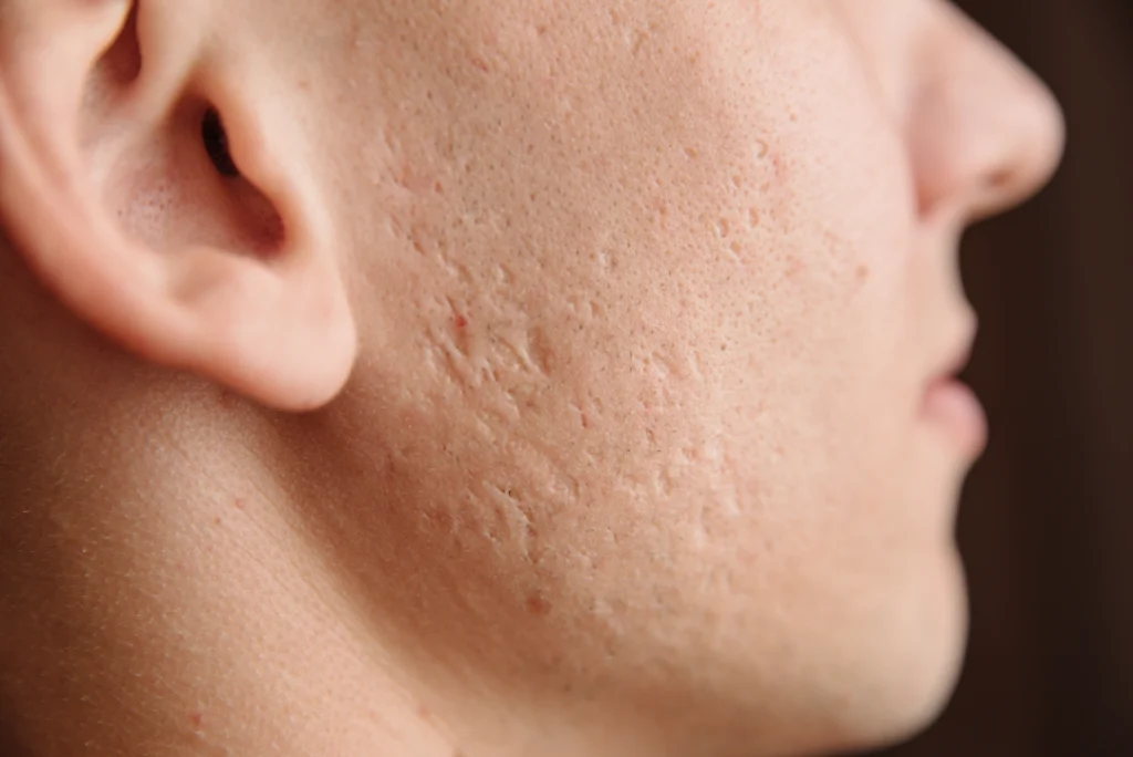 Close-up of acne scars on the cheek, ideal for EzGel treatment to improve skin texture.