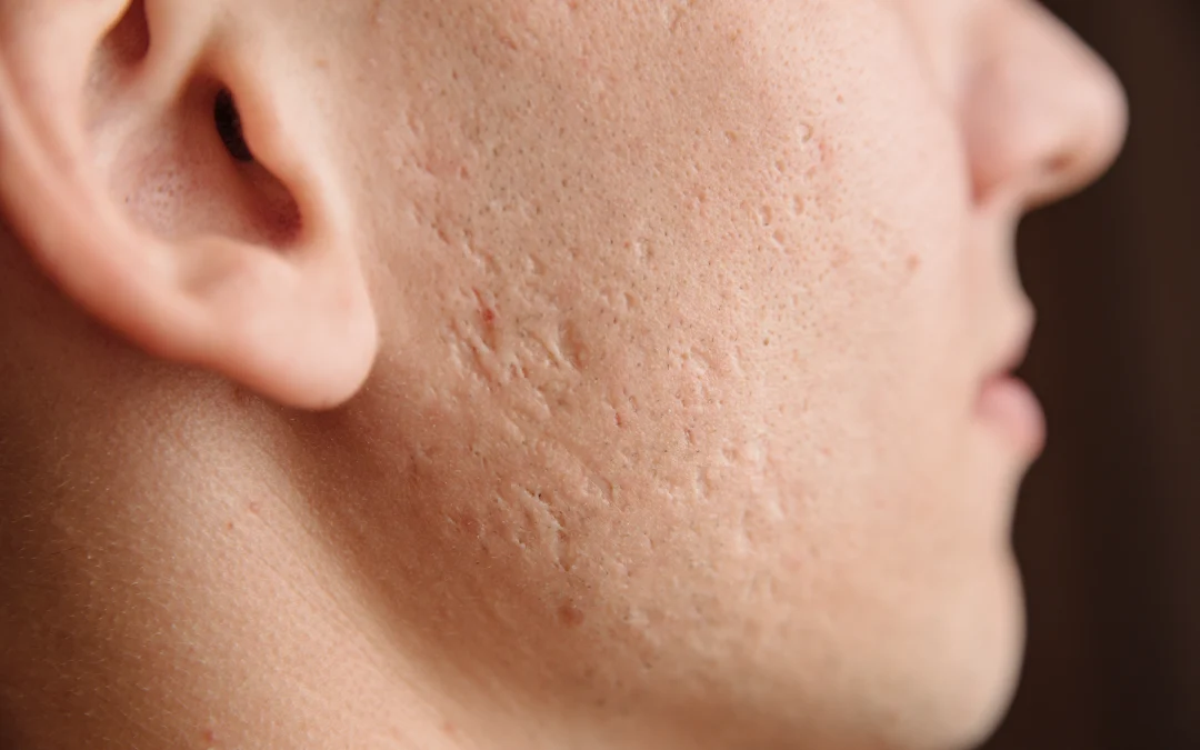 Close-up of acne scars on the cheek, ideal for EzGel treatment to improve skin texture.