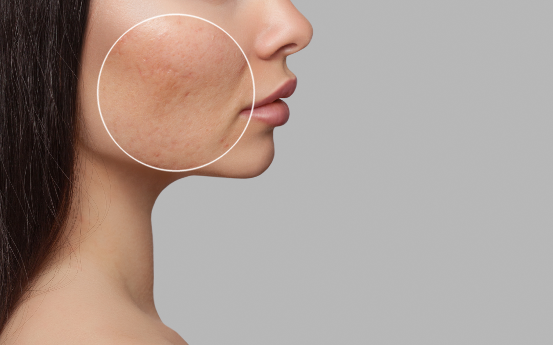 Close-up of acne scars on a cheek before undergoing PRF treatment.