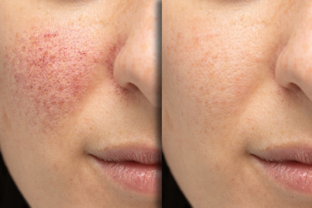 Before and after EzGel treatment showing smoother skin and reduced acne scars.