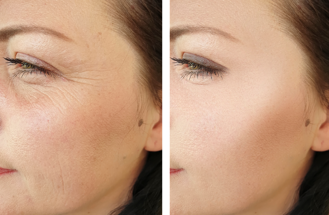 Side-by-side comparison of a woman's face showing the reduction of crow’s feet and fine lines before and after Jeuveau treatment.