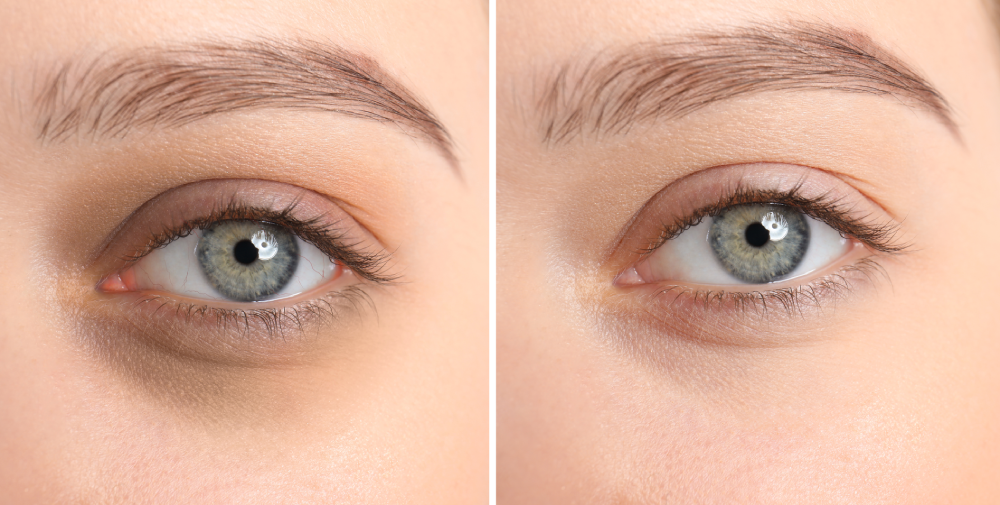 Before and after results of under-eye dermal fillers treatment.