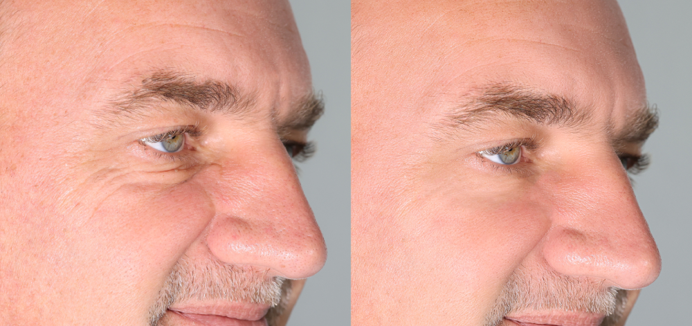 Close-up of man’s face before and after wrinkle treatment with cosmetic dermatology.