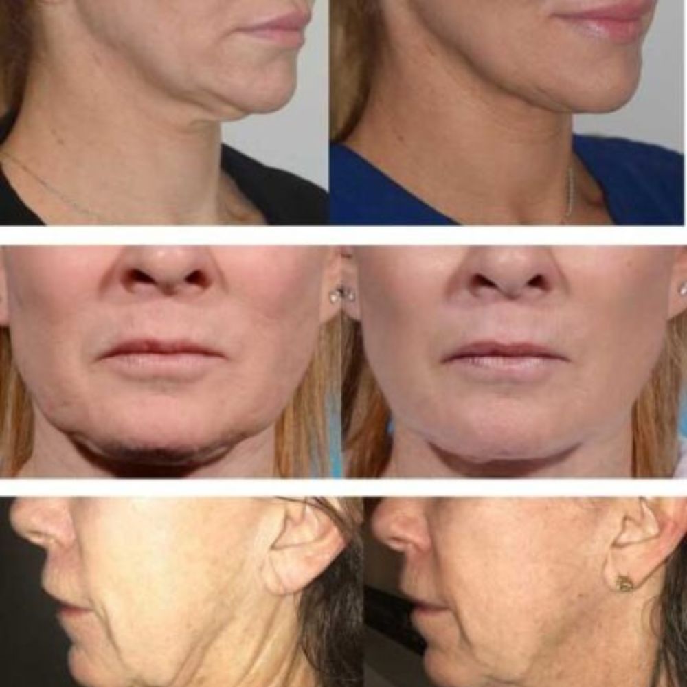 BA-Morpheus8 Burst-2