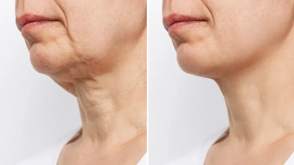 before and after comparison of sagging neck skin improved after treatment